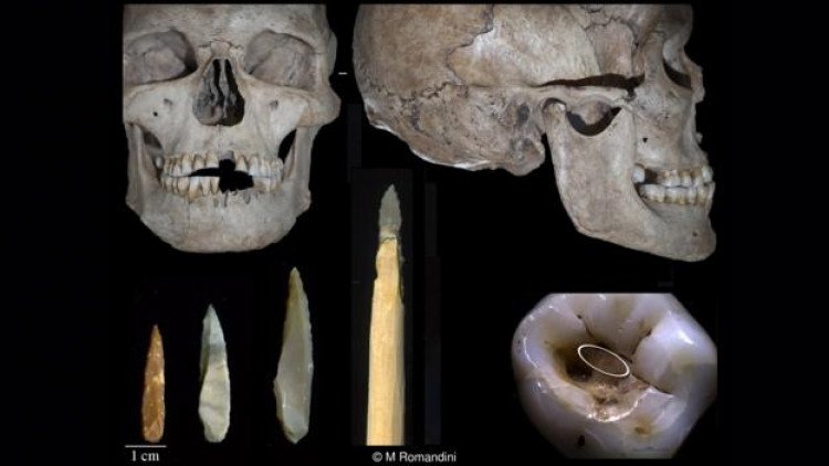 6500 жилийн настай шүдний ломбо: Шүд өрөмдөх, ломбодох явц хэрхэн хөгжиж ир ...