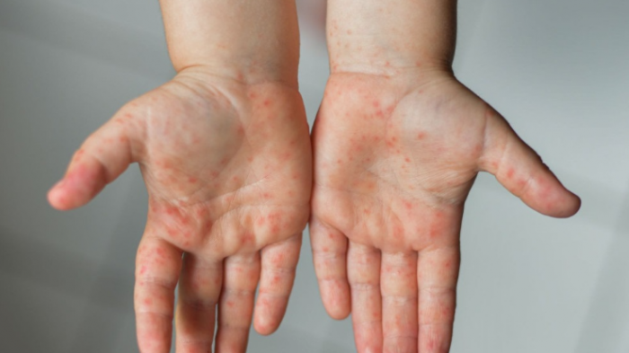 Улаанбурхан өвчний батлагдсан тохиолдол улсын хэмжээнд 14.663 хүрээд байна